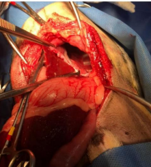Transoperatório: redução dos órgãos