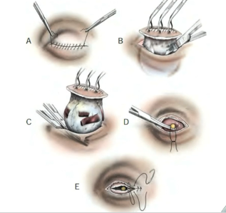 Ilustração completa da técnica de enucleação transpalpebral passo a passo