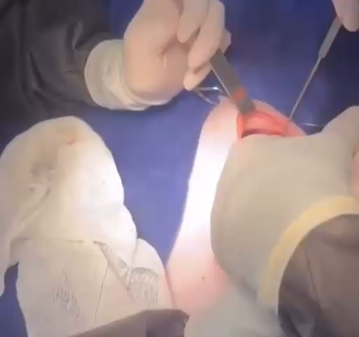 Transoperatório: exposição da cavidade