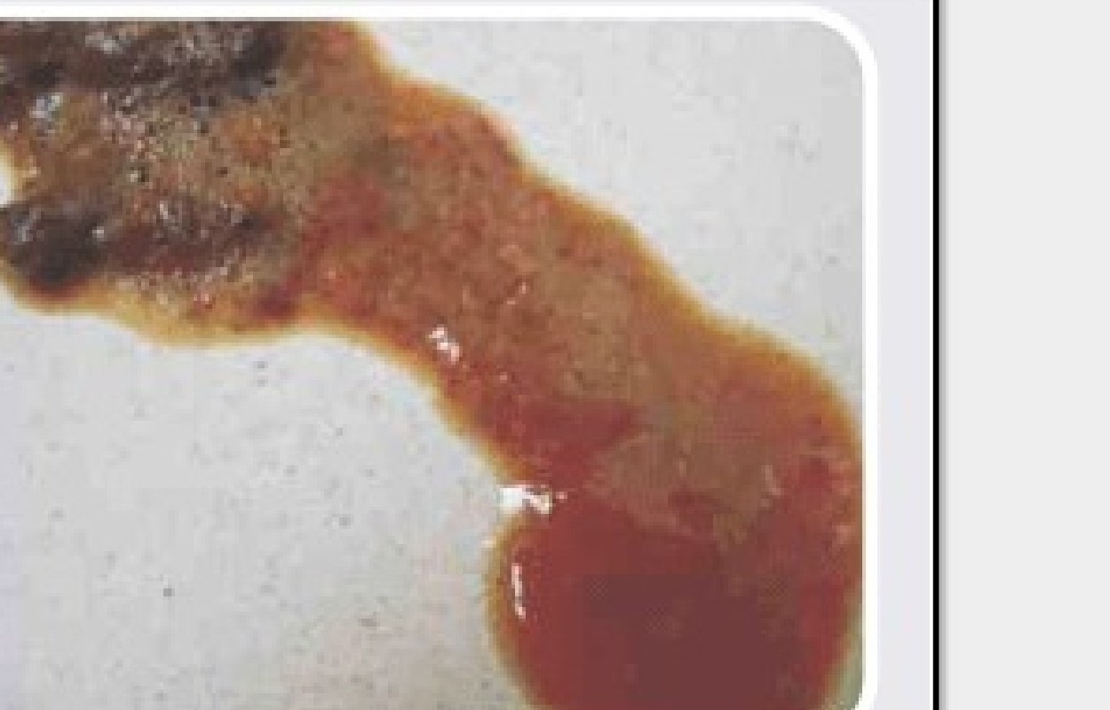 Diarreia de intestino grosso