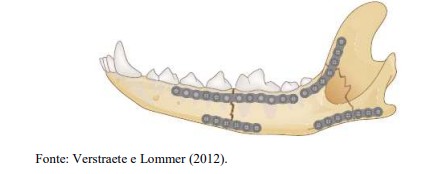 Fixação de fratura mandibular com placas e parafusos