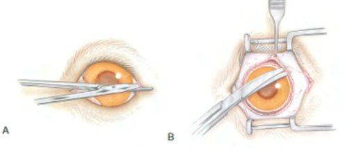 Ilustração da desinserção conjuntival 360 graus ao redor do limbo