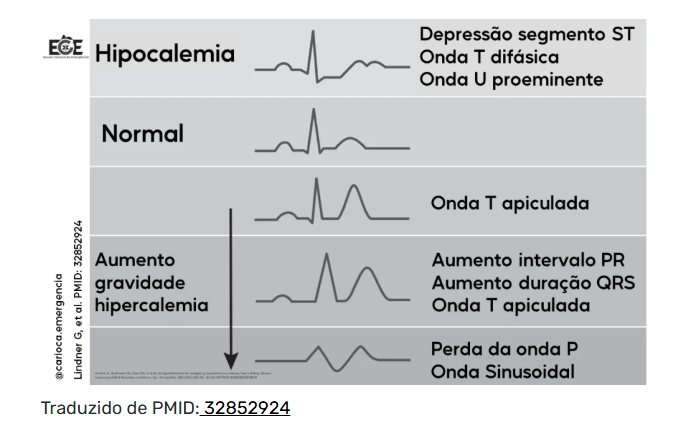 Esquema comparativo de traçados eletrocardiográficos na hipocalemia, normal e na hipercalemia progressiva