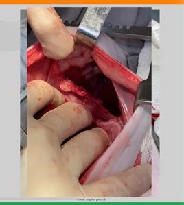 Transoperatório da síntese do diafragma