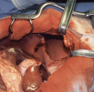 Transoperatório: órgãos herniados