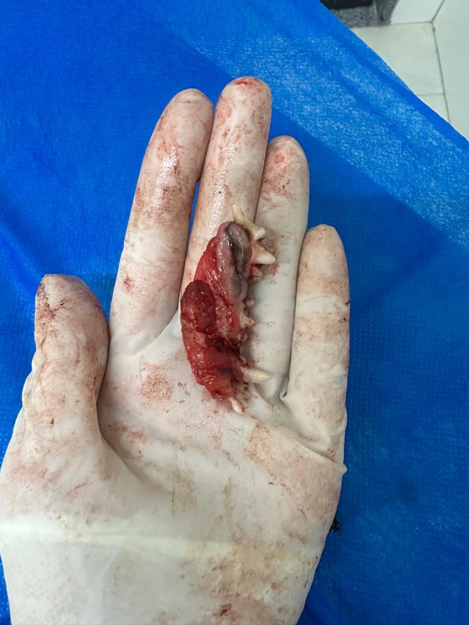 Fragmento ósseo removido com dentes associados
